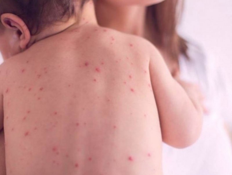 ХӨСҮТ: Улаанбурхан өвчний батлагдсан тохиолдол 3 нэмэгджээ